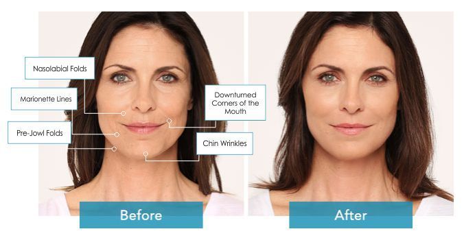 Chin Augmentation With Dermal Fillers 