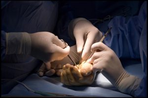 Hand Surgery For Arthritis