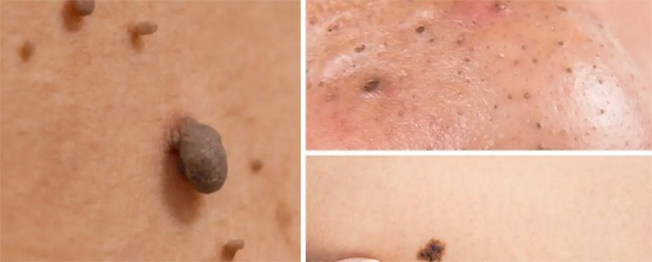 Mole / Skin Tag Removal 