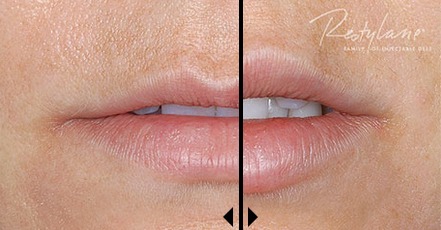 Restylane Dermal Filler Before And After Photos