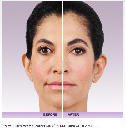 What Is Juvederm Dermal Filler Used For?