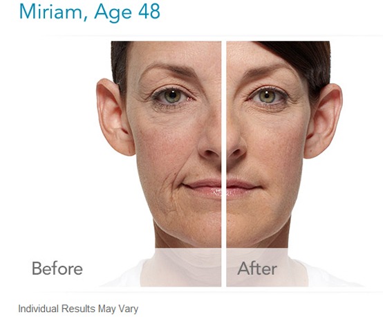 Radiesse Dermal Filler Before And After Images