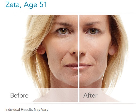 Radiesse Dermal Filler Before And After Images