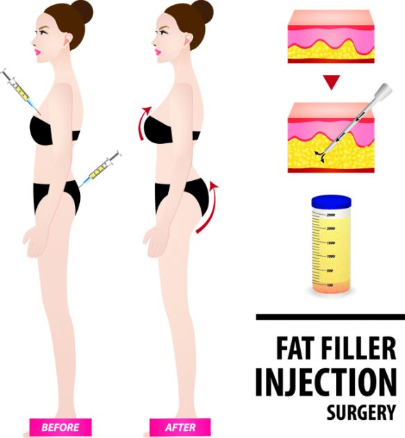 What Is Fat Grafting?